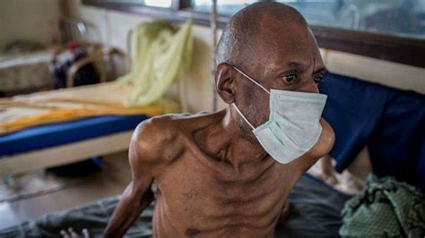 pictures of tb patients.